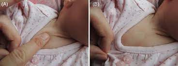 See full list on phc.ox.ac.uk A Demonstration Of The Technique For Capillary Refill Time On The Download Scientific Diagram