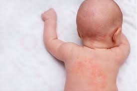الطفح الجلدي عند الأطفال حديثي الولادة أسبابه و أنواعه safar medical