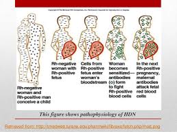 Hemolytic Disease Of Newborn Hdn