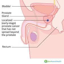But the urology care foundation notes that there may be some warning signs that you have problems related to your prostate, including the following: Prostate Cancer Symptoms Causes And Treatment