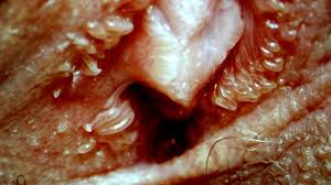 علائم پاپول مرواریدی زنانه