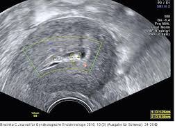 Abbildung 5 Ultraschall Serometra