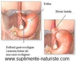 Nad+ is essential to cellular energy production and mitochondrial function. Tratament Naturist Adjuvant Hernie Hiatala Tratamente Naturiste