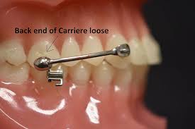 A professional such as dr. Ortho Care From Home Sayre Orthodontics Bozeman Mt