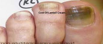 These infections often cause hair loss and if you use lamisil for treatment of the primary cause of the hair loss (tinea capitis) then it is easy to assume that it is the drug causing the thinning, but this is not usually true. Cost Of Lamisil Cream
