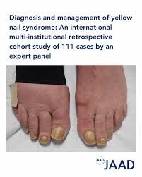 Image result for Yellow nail syndrome feet