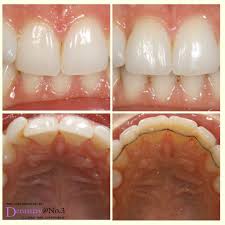 Is pain free dentistry really available? Dentistry At No3 On Twitter High Speed Braces Transformation Give Us A Call On 01383 735710 For Your Pain Free Appointment Dentistryatno3 Dunfermline Cfast Makeover Painfree Braces Highspeedbraces Results Https T Co Rfos4eumbj