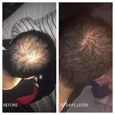 Using tea tree oil makes hair follicles more receptive to nutrition and this promotes overall hair growth. Tea Tree Oil To Reduce Post Hair Transplant Redness Hair Loss Forum Hair Transplant Forums