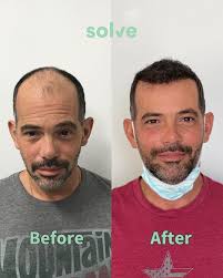 Check out Pete's incredible FUE hair transplant transformation 👨🏻 Check  out our website for more information & schedule your complimentary hair  restoration consult today! #chicagohairclinic #chicagohairtransplant  #hairtransplanttransformation ...