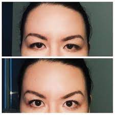 To create the double fold, he makes a short incision in the upper eyelid. Is A Brow Lift Recommended For Uneven Eyebrows Hooded Asian Eye Angry 11s If Brows Are Naturally Very Arched Photos