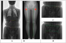 Image result for Functional Leg Length Discrepancy