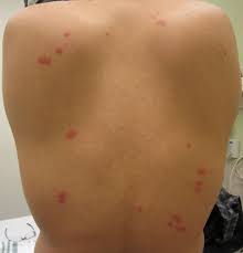 Image result for scabies bite