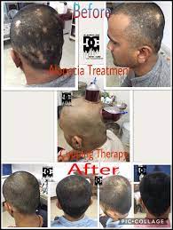 If the body is unhealthy this will reflect the outside of the body too. Alopecia Treatment Bal Koraah Hijama Cupping Therapy Facebook