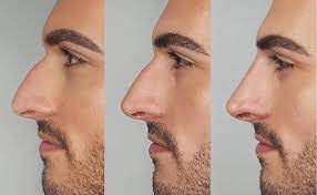 There is an optional additional fee of £150 for rhinoplasty imaging. Non Surgical Nose Job Nose Filler Reshaping London Uk 3 Point Rhino