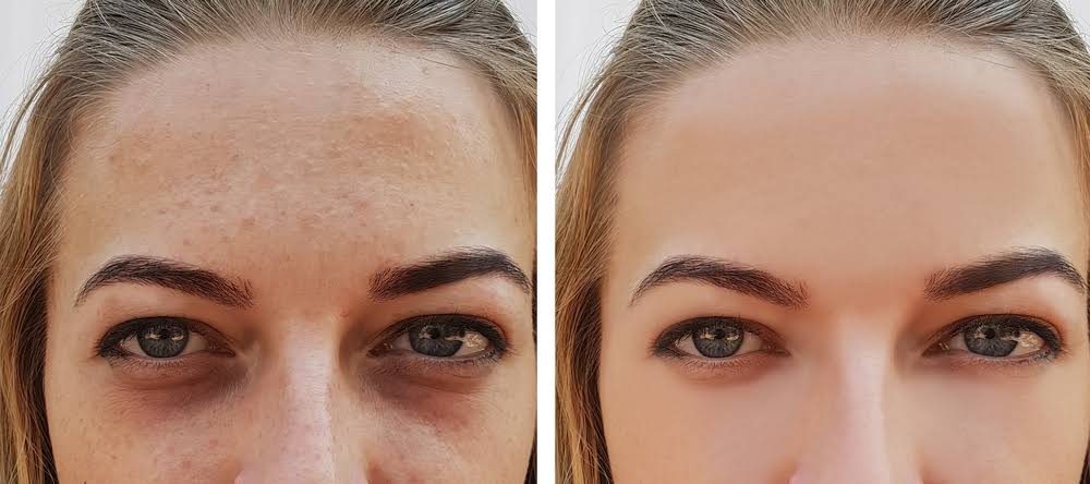 Micro needling product image
