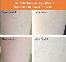 Brazilian removal is the removal of all hair in the pubic region. Follow My Laser Hair Removal Experience Legs Brazilian And Random Other Areas Lasers Laserhairremoval Brazili Laser Hair Removal Hair Removal Laser Hair