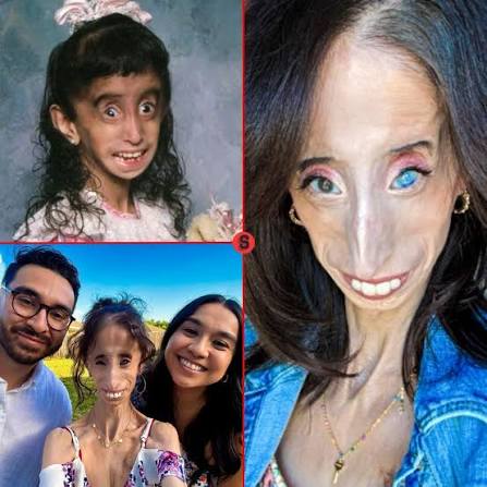 Nació con una rara enfermedad genética que le impide acumular grasa  corporal o ganar peso: Lizzie Velásquez, estadounidense, vino al mundo en  1989 en el estado de Texas. Solo un pequeño grupo