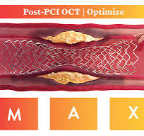 Optical Coherence Tomography (OCT) Intravascular Imaging ...