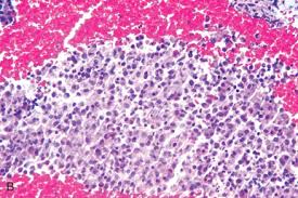 Basosquamous carcinoma is a rare aggressive variant of basal cell carcinoma (bcc) which had tendency to recurrence and metastasis. Adenocarcinoma Carcinosarcoma And Other Epithelial Tumors Of The Endometrium Sciencedirect