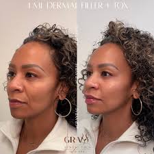 4 ML Dermal Filler + Tox = Subtle, Stunning Refresh, AGING BACKWARDS ✨ This  gorgeous #GrayBae traveled all the way from the South and received a total  of 4 mL of dermal