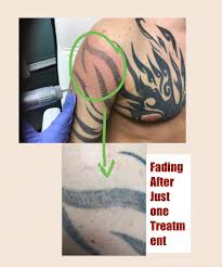 Today i talk about and state why im switching to a new clinic and why i've decided to pay a. Tribal Fade After One Treatment Maria Patricia Laser Tattoo Removal Laser Hair Removal Carbon Laser Skin Rejuvenation Dermal Rollers