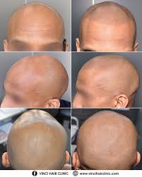 Msp Results Vinci Hair Clinic London Hair Clinic Micro Scalp Pigmentation Short Hair Growth