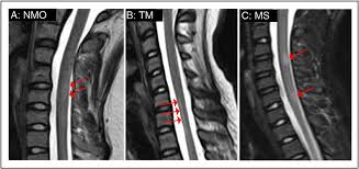 Image result for Myelitis