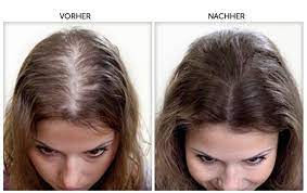 hairvox vorher nachher erblich bedingter haarausfall haare vorher nachher kokosol haare vorher nachher