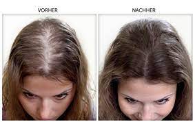 Die kosten der haarimplantation wird von den patienten sehr sehr ernst genommen, obwohl es genau so wichtig ist, wie alle anderen ästhetische operationen die am körper durchgeführt werden. Hairvox Vorher Nachher Erblich Bedingter Haarausfall Haare Vorher Nachher Kokosol Haare Vorher Nachher