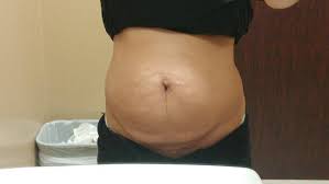 In fact, fat is behind the biggest epidemic on the planet: Is It Fat Or Loose Skin Photos