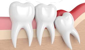 Your dentist can quickly remove spicules with tweezers. Wisdom Teeth Removal London Victoria Dental Centre