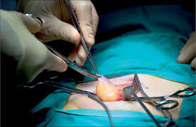 In this article what is an umbilical hernia? Time For Use Of Mesh Repair For All Umbilical Hernias The Lancet
