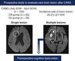 Image result for Brain Lesion