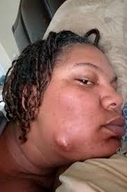 Boils or cysts are associated with some conditions including remember that it is not recommended that you pop or squeeze a boil but rather let it drain on its own of lance it when ripe. Gross Video Shows Giant Abscess On Woman S Cheek Erupt As It S Sliced Open And Drained
