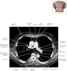 The largest lymphatic vessel that passes through the chest and drains into the subclavian vein. Cisterna Chyli And Thoracic Duct Clinical Gate
