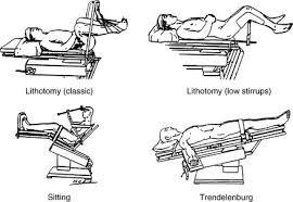 Normally when a person is lying flat on a flat table, the head and legs are at same level. 20 Patient Positioning Anesthesia Key