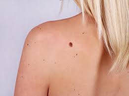 Of course, your specialist is the main person whose advice you should follow but it doesn't do anyone harm. Melanoma Skin Cancer What Moles To Look Out For The Independent The Independent