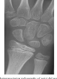 Image result for Scapholunate Dislocation