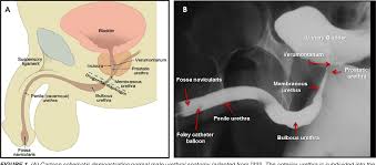Image result for Retrograde Urethrogram
