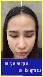 ដាំសក់ Hair Transplant Cambodia