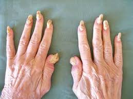 Image result for Akutní zánět nehtového lůžka