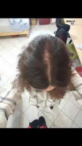 Inoltre, vi è una predisposizione ereditaria nei confronti dell'alopecia . Diradamento Riga Centrale