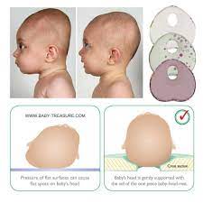Baby Treasure Com On Instagram The Head Of Your Baby Is Dented This Is The Result Of A Constant Pressure On One Spot Flat Head Syndrome Baby Head Baby Fever