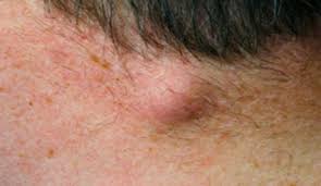 Check spelling or type a new query. Bumps On Back Of Head After Haircut Treatment Novocom Top