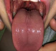 Image result for Puchýře na jazyku