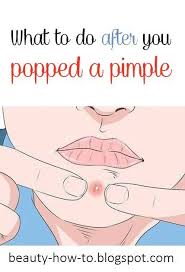 What To Do After You Popped A Pimple Pimples How To Remove Pimples Best Medicine For Pimples