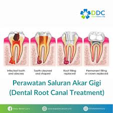Pemakaian gigi palsu tidak hanya untuk orang tua atau lansia saja yang giginya tanggal. Layanan Diana Dental Care