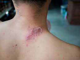 Image result for zoster under breasts