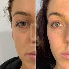 Has My Lip Filler Migrated? Are My Lips Normal? - L1P Aesthetics