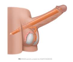 Penile implants - Patient Information
